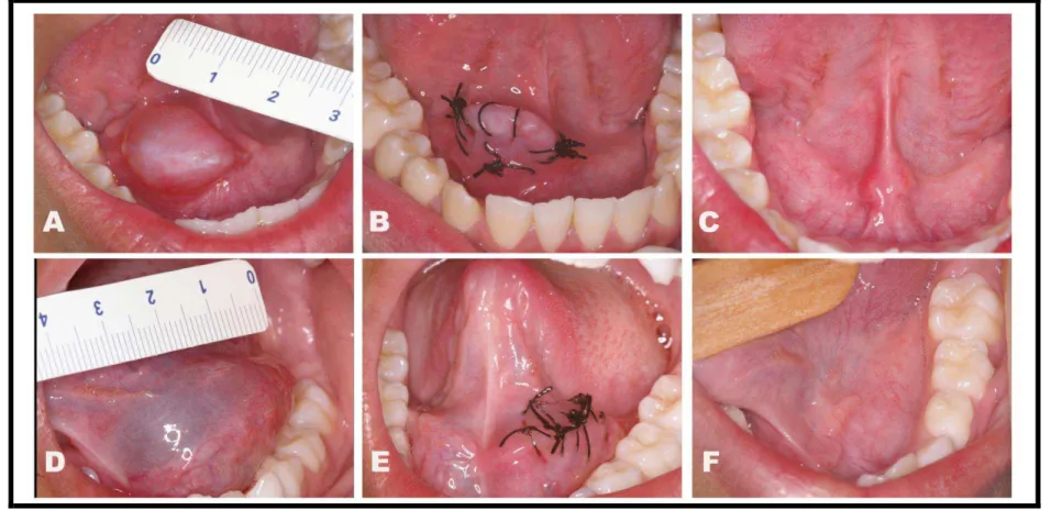 Figure 2 - Patients #3 and #8. Clinical aspects of oral ranulas and upgraded micro-marsupialization technique