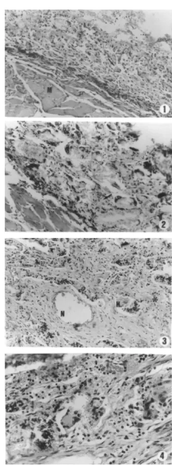 Figure 2. Periphery of the hydroxyapatite nodule. Ob- Ob-serve the hydroxyapatite granules surrounded by giant cells (arrow )