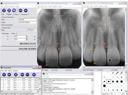 Figura  2  –  Seleção  dos  pontos  de  controle  nas  imagens  radiográficas  pré  e  pós- pós-tratamento ortodôntico 
