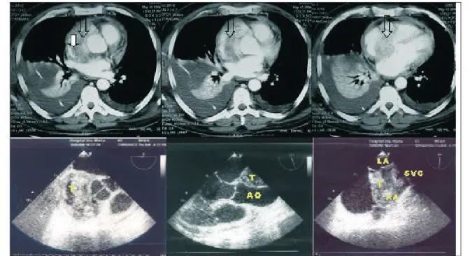 Figure 1 a, b, c: Thoracic angio-CT: three consecutive thoracic CT images after intravenous contrast, showing extensive solid lesion (open arrow), with heterogeneous contrast enhancement, diffusely infiltrating the right atrial wall, reducing its lumen.