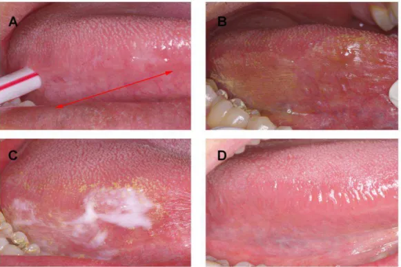 Fig. 1  – Oral hairy leukoplakia (OHL) treated with 25% podophyllin resin together with a 1% 