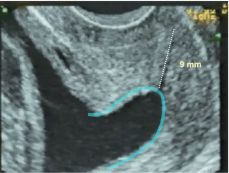 Figure 2. Normal (36 mm) cervical length measurement.