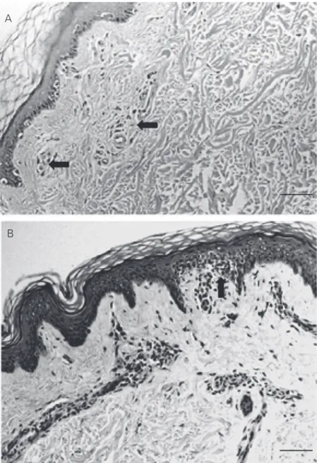 Figure 1. Normal skin biopsies obtained from HIV+ patients. Two different patterns of superficial dermal cellular infiltrate are shown