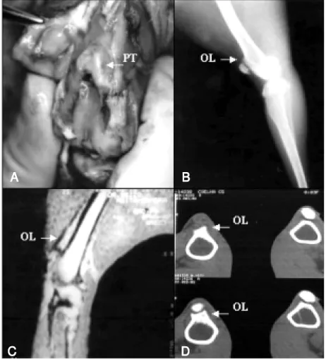 Figure 4. Proliferating tissue and osteochondral lesion in the proximal trochlear groove of an immobilized knee (animal number 5)