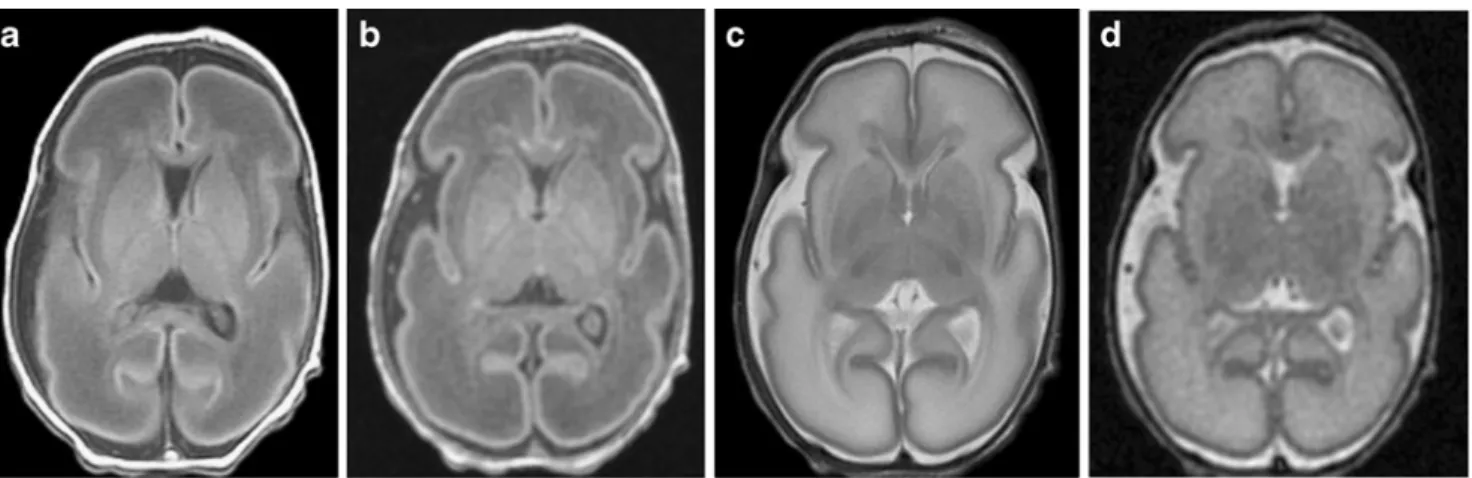 Figure 1 shows clinical and research T 1 -W and T 2 -W representative axial images, corresponding to the chosen sequences presented in Table 1, of a preterm neonate born at 29 weeks and scanned at 30.57 weeks