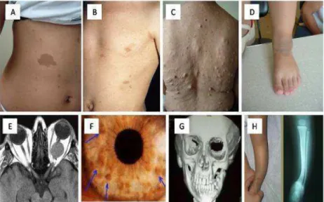 FIGURA 2: Imagens das lesões que constituem critérios diagnósticos para a NF1. A) Manchas cor de  café-com-leite;  B)  Efélides  similis  axilares;  C)  Neurofibromas  cutâneos  e  subcutâneos;  D)  Neurofibroma plexiforme pequeno no tornozelo; E) Glioma ó