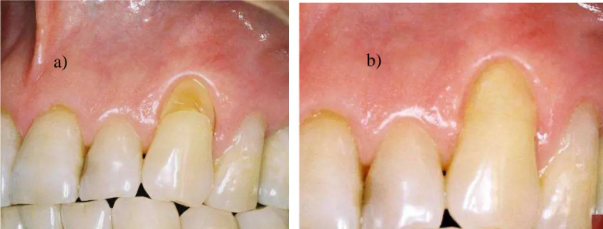 Figura 1 - a) canino superior esquerdo apresentando recessão gengival associada à lesão  cervical  não-cariosa;  b)  após  o  tratamento  somente  com  restauração  adesiva,  a  discrepância entre as margens gengivais foi mantida e o dente está com aspecto