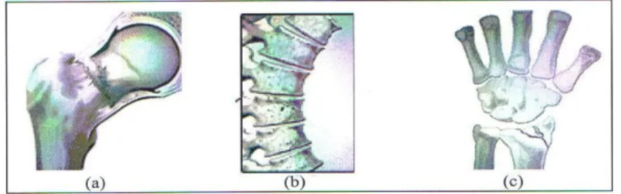 Figura 4 – Tipos de Fracturas Osteoporóticas ( 1 )                                                   