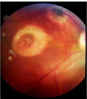 Figura 1 – Retinografia mostrando cicatrizes de retinocoroidite em zona 1 do  olho direito de um RN com toxoplasmose congênita