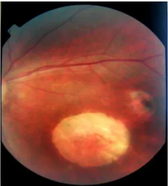 Figura 3 – Retinografia mostrando cicatriz de retinocoroidite na Zona 1 do  olho esquerdo de um RN com toxoplasmose congênita