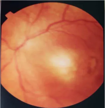 Figura 4 – Retinografia mostrando foco de retinocoroidite necrosante na  zona 1 do olho esquerdo ao lado de uma lesão cicatrizada já iniciando  pigmentação
