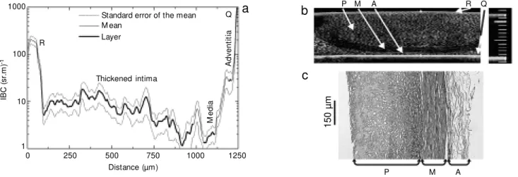Figure 3. a, Integrated backscatter coefficient (IBC) profile across the vessel w all layers; b, ultrasound biomicroscope (UBM ) image; c, histological image of an artery w all including the intima (I) at an early stage of thickening, media (M ), adventiti