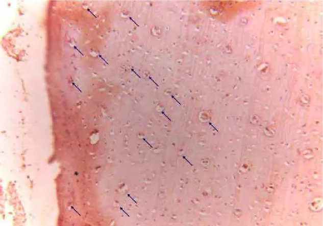 Figura 16 – Expressão de RANKL no G4 (Aumento de 200x). Observar marcação no  citoplasma dos osteócitos