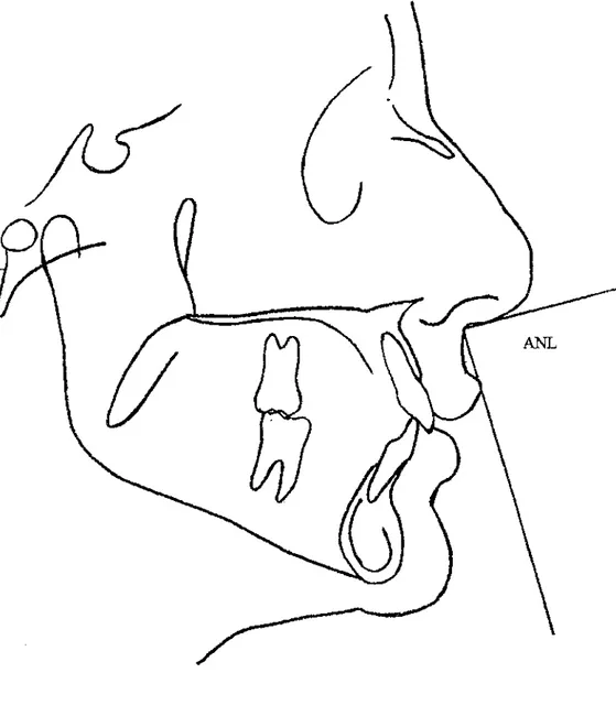 FIGURA 6- Traçado do  ângulo nasolabial (ANL) 