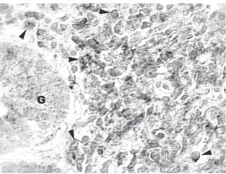 Figure 1. Chronic gastritis: most lymphocytes show membrane reaction with anti-CD95/