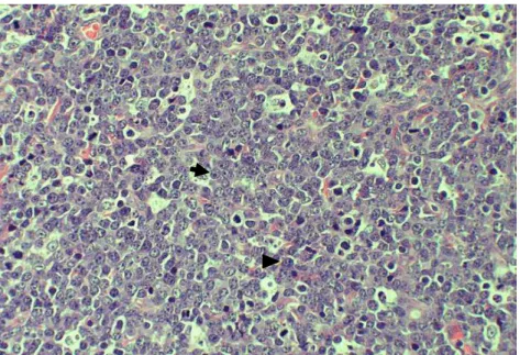 Figura  1  Fotomicrografia  de  LDGCB  em  linfonodo  de  cão.  Observam-se  células  linfoides malignas em padrão difuso de formato arredondado com núcleos  amplos,  moderado  pleomorfismo,  citoplasma  escasso  e  nucléolo  central  (seta) ou múltiplos n