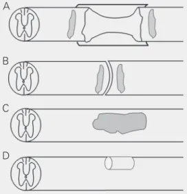 Figure 1. Schematic representation of various spinal cord repair models. In all cords rostral is on the left and dorsal is up