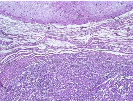 Figure 1 Carcinoma ex-pleomorphic adenoma. Note the benign component (at the top) and the malignant component (at the bottom) (HE 10x).