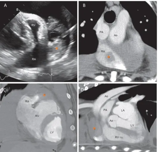 Figura 9- Imagem de ecocardiografia em modo 2D (A) e imagens de tomografia computorizada (TC) por contraste  em corte transversal (B), dorsal (C) e sagital (D) de um cão com hemangiosarcoma localizado na aurícula direita