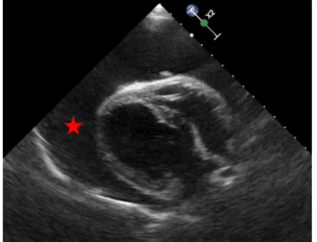 Figura  12:  Imagem  ecocardiográfica  (plano  paraesternal direito de eixo longo) de derrame  pericárdico  onde  é  evidente  o  espaço  anecoico  a  rodear  o  coração  (    )  (Imagem  gentilmente  cedida  pelo  Hospital  Veterinário  de Mollins)