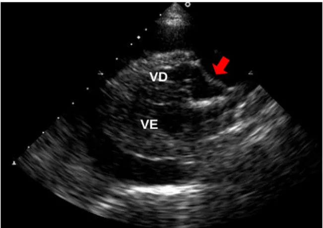 Figura  13:  Imagem  ecocardiográfica  (plano  paraesternal direito de eixo longo 4 câmaras) de  derrame  de  pericárdio  visualizado  como  um  espaço  anecoico  a  rodear  o  coração  e  tamponamento cardíaco evidente pelo colapso do  átrio  direito(seta