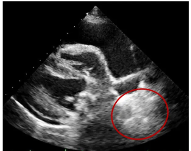 Figura 14: Massa no átrio direito – Imagem  ecocardiográfica (plano paraesternal direito  de  eixo  curto)  (Imagem  gentilmente  cedida  pelo Hospital Veterinário de Mollins).