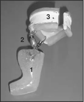 Figure 2. Orthosis in the neutral ankle position consisting of an acrylic resin model (1), lateral rotators (2) and an abdominal belt (3).