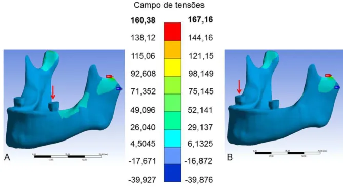 Figura 7 - Análise da distribuição de tensões sofrida na mandíbula quando aplicada  cargas em dois pontos distintos; A- na oclusal do primeiro molar inferior esquerdo; 