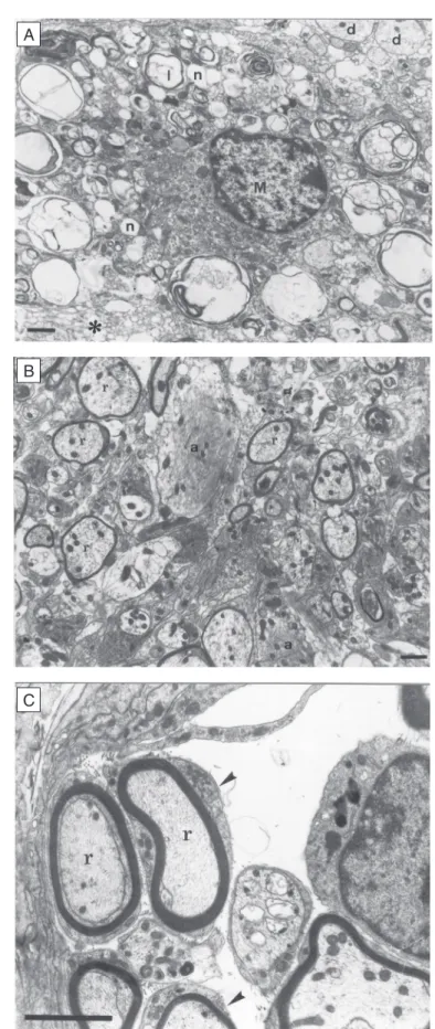 Figure 1. Group IV. A, 7 days after ethidium bromide injection. A macrophage (M) containing myelin at  differ-ent stages of degradation, including lamellae (l) and neutral fat droplets (n) in an area of enlarged  extracel-lular space filled with myelin deb