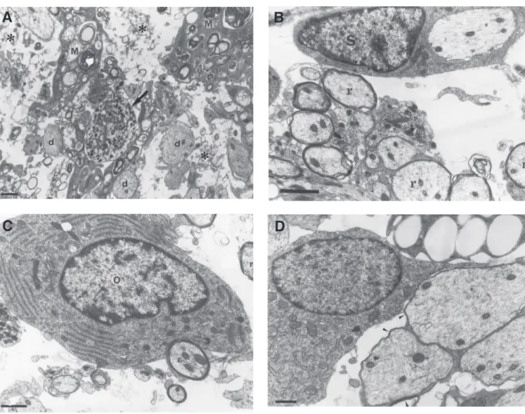 Figure 2. Group I. A, 7 days after ethidium bromide injection. Demyelinated axons (d) in an area containing large amounts of myelin-derived membranes (asterisks), phagocytic cells (M) and even a degenerating axon (arrow)