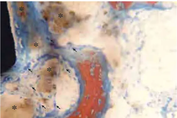 Figura 25 - Grupo tratado. Período de 60 dias. Presença de tecido conjuntivo  com inúmeros osteoblastos (setas) na área medular, envolto pelo  remanescente do PLA/PGA (*) (Vermelho de alizarina e azul de Stevenel,  original de 400X)