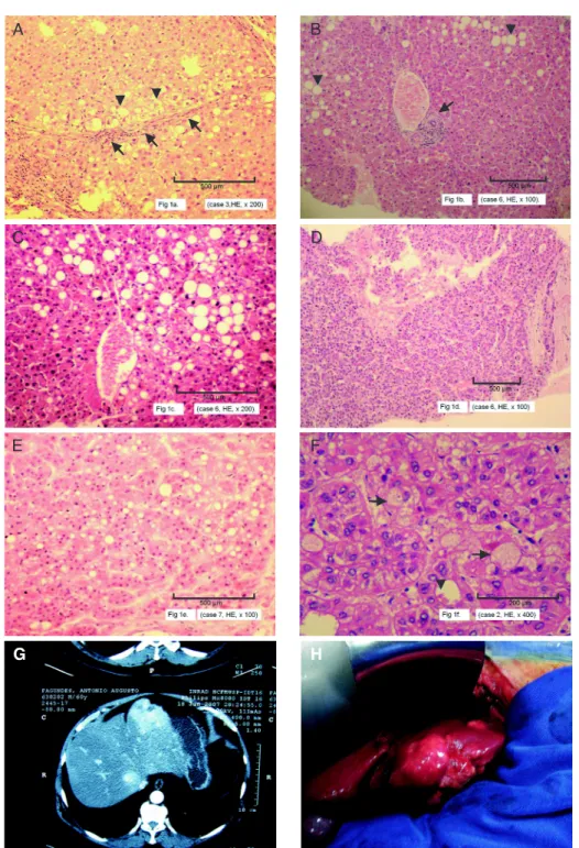 Figure 1. Microscopic features of non-neoplastic areas and of hepatocellular carcinoma (HCC)