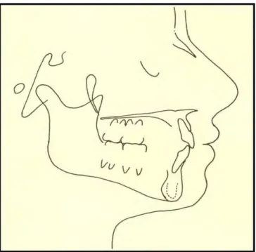 Figura 1. Traçado cefalométrico de paciente mesofacial. Observa-se uma harmonia facial  sendo a relação maxilo-mandibular correta