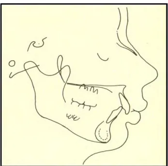 Figura 3. Traçado cefalométrico de paciente braquifacial. Observa-se uma diminuição da  altura facial ântero-inferior
