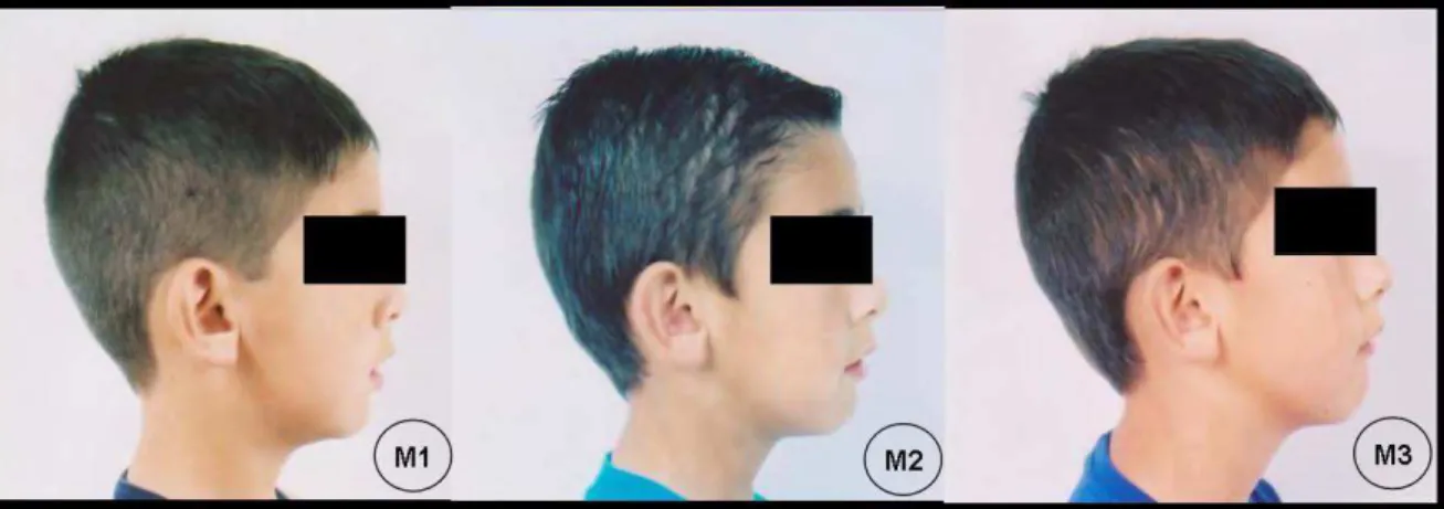 Figura 6. Avaliação clínica para retrognatismo mandibular em M1, M2 e M3. 