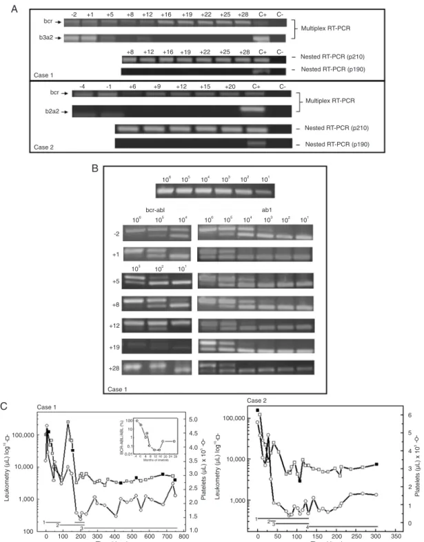 Figure 1. Analysis of the hematological responses to treatment in 2 children with chronic myeloid leukemia and molecular analysis