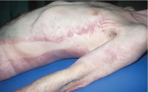 Fig. 2- Example of pallor mortis, denoted by the pallidity of the skin. Adapted from 