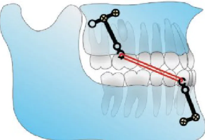 Figura 13- Dispositivos de ancoragem óssea (Adaptado de Fakharian et al., 2019) 