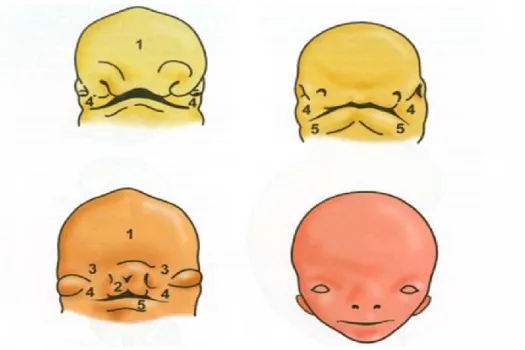 Figura 2 – Etapas sequenciais de formação da face: 1- processo frontonasal; 2 – processo nasal  medial; 3 – processo nasal lateral; 4 – processos maxilares e 5 – processos mandibulares (Ferreira,  2008)