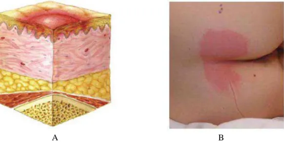 FIGURA 2.3- Úlcera por pressão categoria I: A- representação da lesão avermelhada na superfície; B-  imagem da úlcera (em vermelho) na pele (NUAP/EPUAP, 2014) 