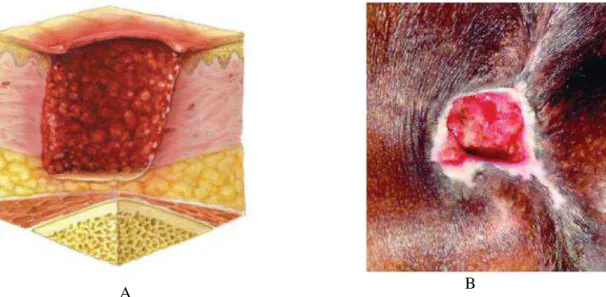 FIGURA 2.6- Úlcera por pressão categoria IV: A- representação da perda dos tecidos; B- úlcera com  tecido desvitalizado na pele (NUAP/EPUAP, 2014) 