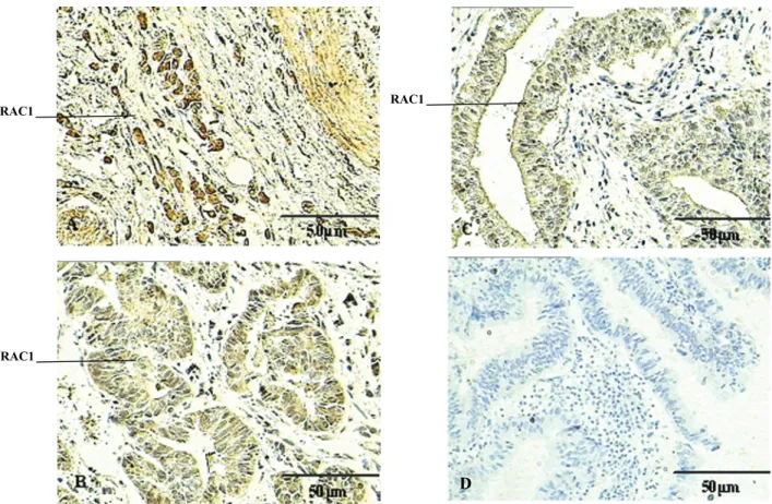 Figure 1. Expression of the Rac1 protein (arrows) in extrahepatic cholangiocarcinomas