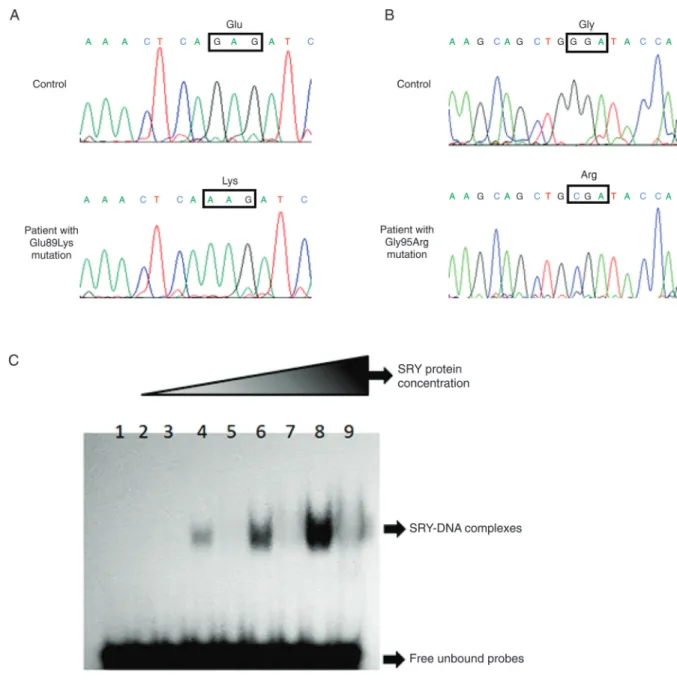 Figure 1. Partial electropherograms of SRY gene DNA sequences of normal control and patients with 46,XY complete gonadal  dysgenesis are shown
