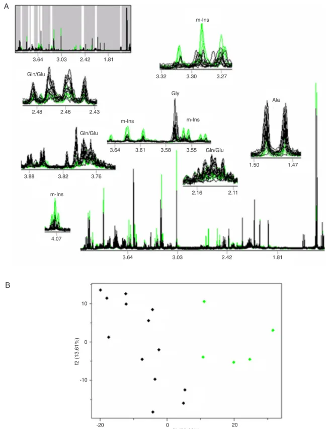 Figure 2. A,  1 H MRS spectral profiles. Full spectra superimposed with the metabolites of interest highlighted (superior, left) and the  expanded regions of interest to emphasize the differences between high-grade neuroglial tumors (black) and low-grade n