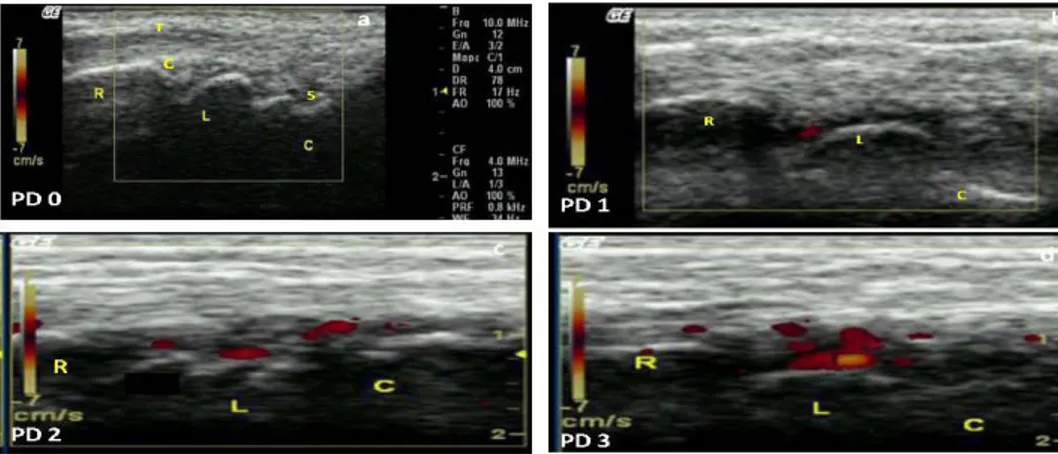 Figure 2.  Synovitis identified by power Doppler (PD) ultrasound in a dorsal longitudinal wrist scan