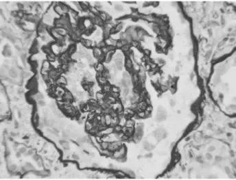 Fig. 4. Microcystic dilatation of the tubules that are filled with proteinaceous casts (Masson trichrome stain ×400).