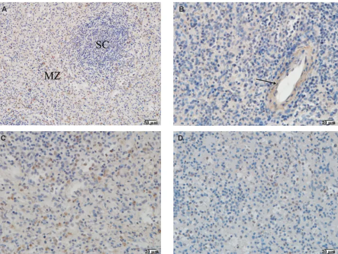 Figure 1. Detection of the expression of YKL-40 by immunohistochemical staining. Positive expression (brown) of YKL-40 occurred in  the cytoplasm