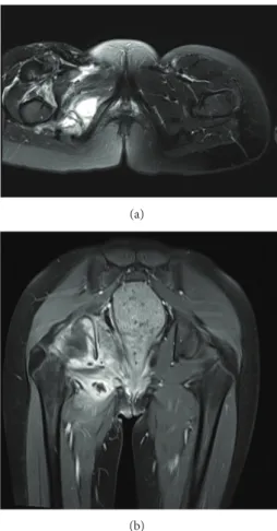 Figure 1: Bilateral pneumonia with effusion.