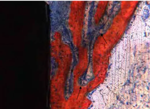 Figura 7 – Grupo tratado, 21 dias (região cervical). Trabéculas de osso neoformado  preenchendo parcialmente a área do defeito ósseo peri-implantar, envoltas por  tecido conjuntivo celularizado, com células semelhantes a osteoblastos (setas)  (vermelho de 