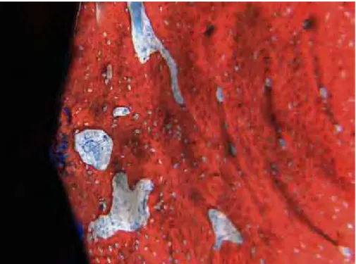 Figura 11 – Grupo controle, 60 dias (região cervical). Neoformação óssea na região  do defeito peri-implantar e presença de trabéculas ósseas circundadas por tecido  conjuntivo celularizado com espaços de remodelação (setas) (vermelho de alizarina  e azul 